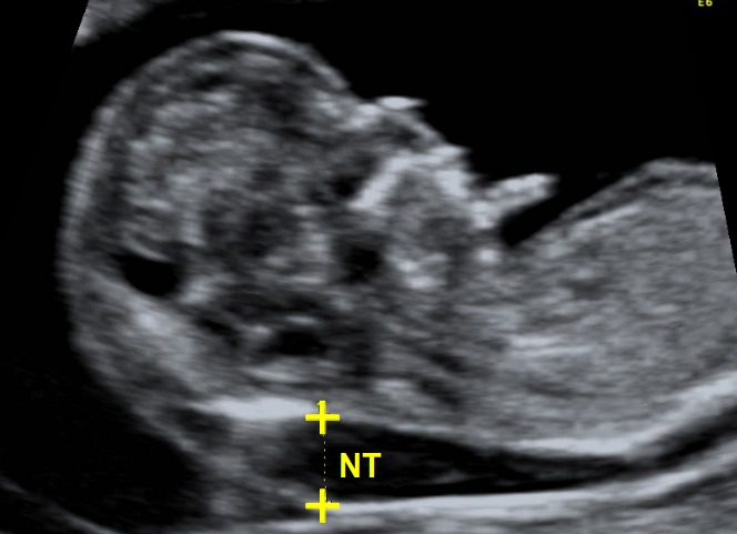 Nuchal translucency (NT) marked above on ultrasound (source) 