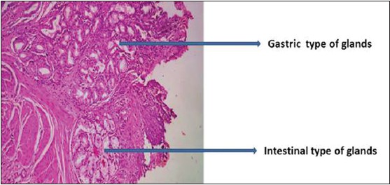Presence of gastric glands can be observed in removed tissue from a Meckel diverticulum (source) 