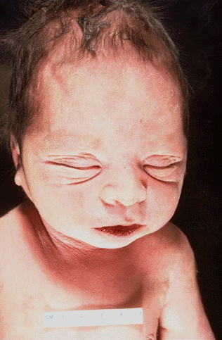 Classic facial features seen in a neonate with Potter's syndrome (source)