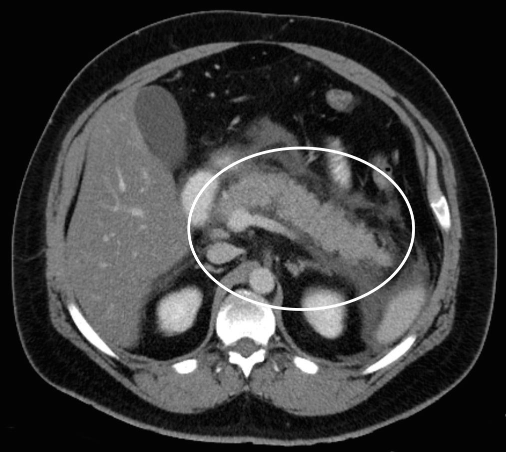 Acute exudative pancreatitis seen on CT scan (source) 