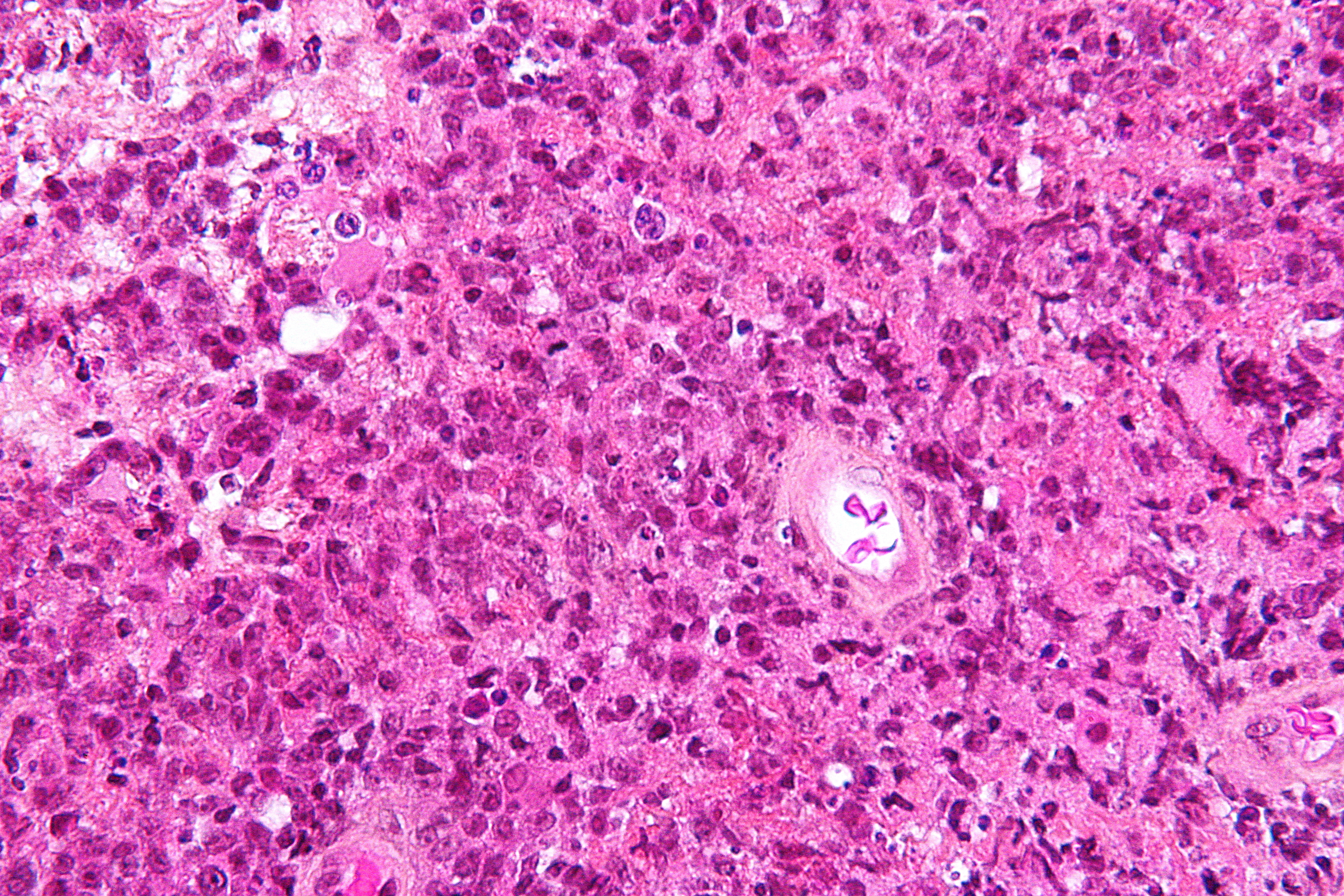 Biopsy of primary CNS lymphoma (source) 