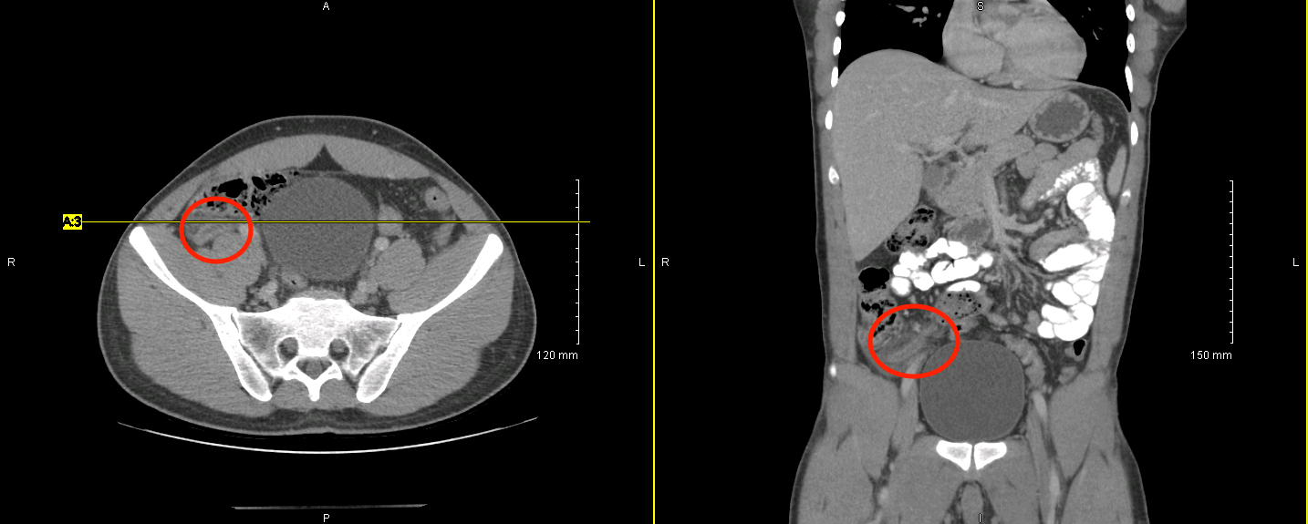 Abdominal/pelvic CT scan (both oral and IV contrast given) of a patient with appendicitis. 
