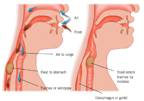 Aspiration Pneumonia - Stepwards