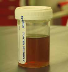 Tea colored urine sample from a patient with rhabdomyoosis (source) 