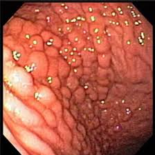 Classic "cobblestone appearance" of Crohn disease on endoscopy (source) 
