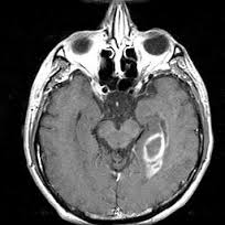 MRI of a patient with a primary CNS lymphoma (source) 