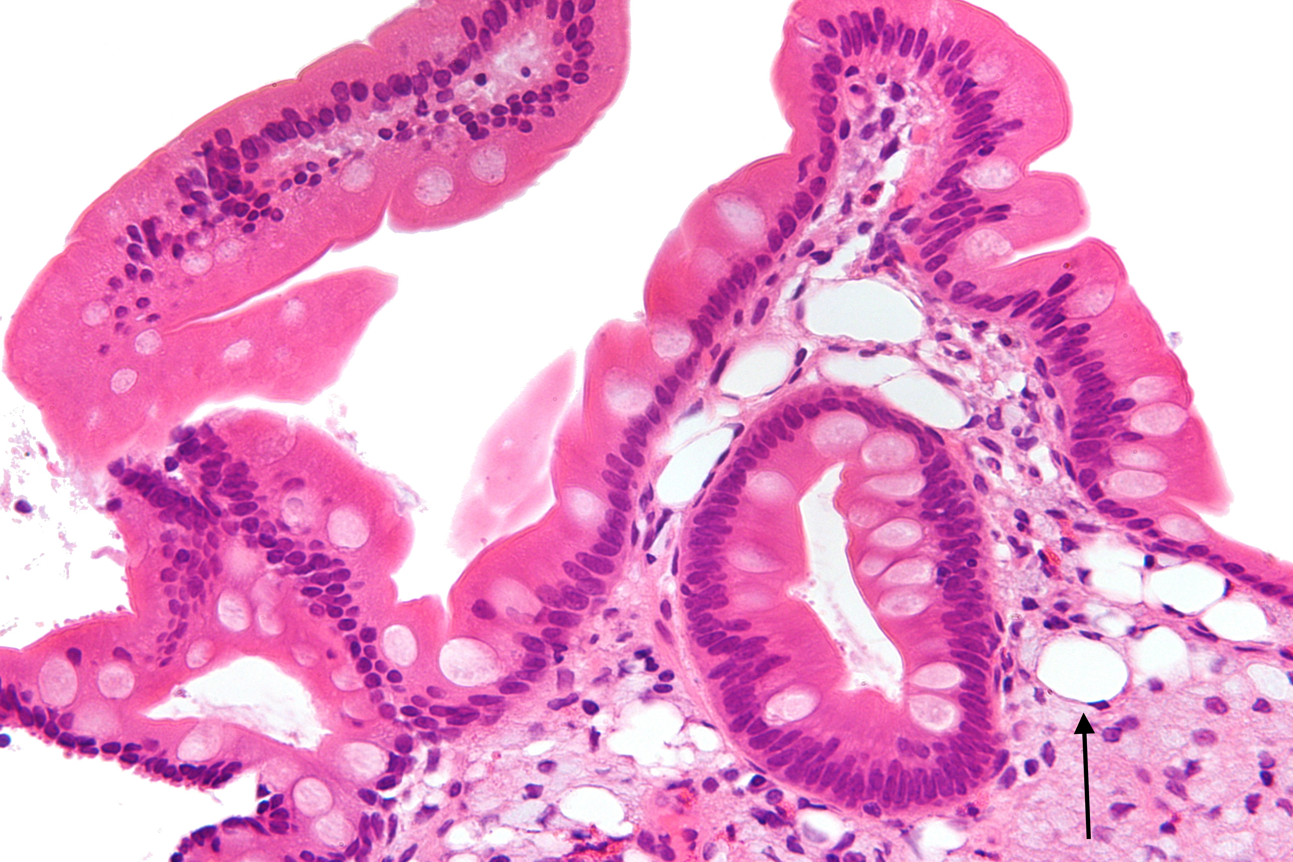 The presence of foamy macrophages (arrow) can be seen on histology in Whipple disease (source) 