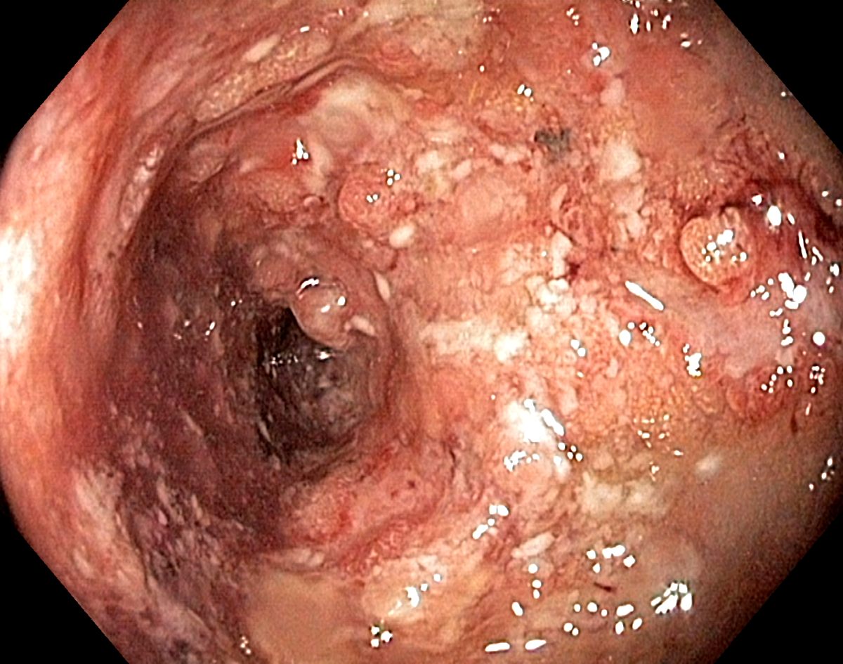 Endoscopic appearance of ulcerative colitis (source)