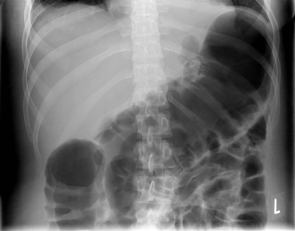 Abdominal X-ray showing drastic dilation of the colon (source) 