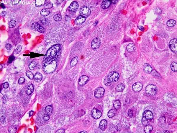 Pleimorphic chroffafin cell nuclei seen on histological analysis of pheochromocytoma (source) 
