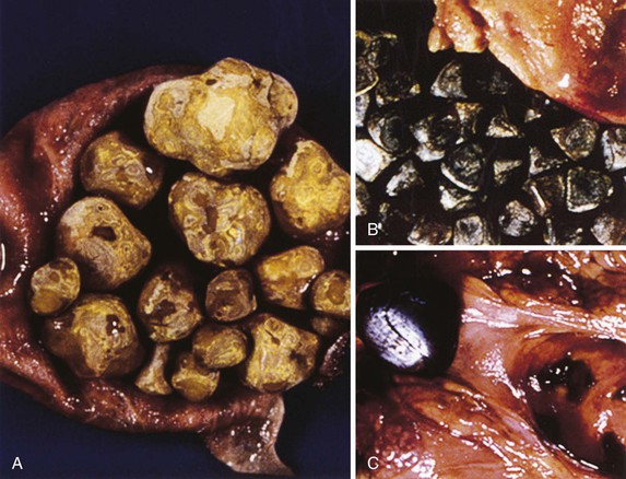  Cholesterol gallstones (A), black stones (B), and brown stones (C) can be found within the gall bladder/bile duct bile ducts (source) 