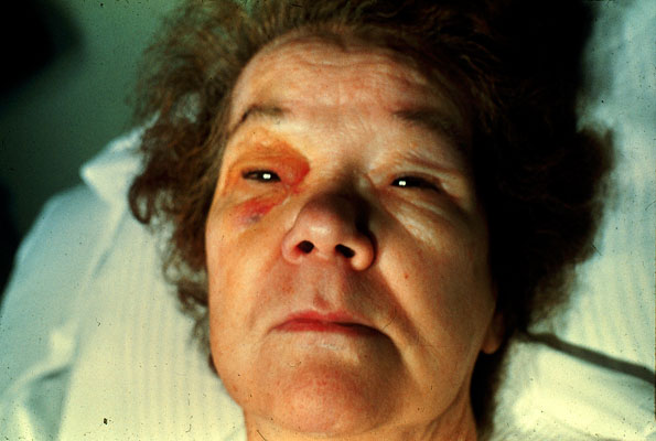 Clinical presentation of periorbital myxedema in a patient with hypothyroidism. Myxedema is swelling of the skin and underlying tissues that appears to have a waxy consistency (source) 