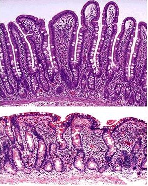 Biopsy of normal small intestine (top) compared to a biopsy from a patient with celiac disease (bottom). Blunting of villi can be clearly appreciated (source) 