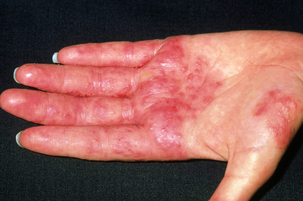 Contact dermatitis on the hand of a patient (source) 