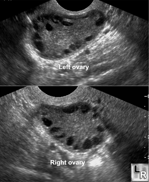 Pelvic ultrasound of a patient with polycystic ovary syndrome in both ovaries (source) 