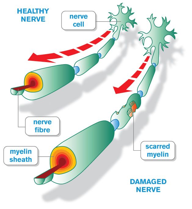 This autoimmune reaction ultimately results in the damage of the myelin sheath of neural axons within the CNS (source)