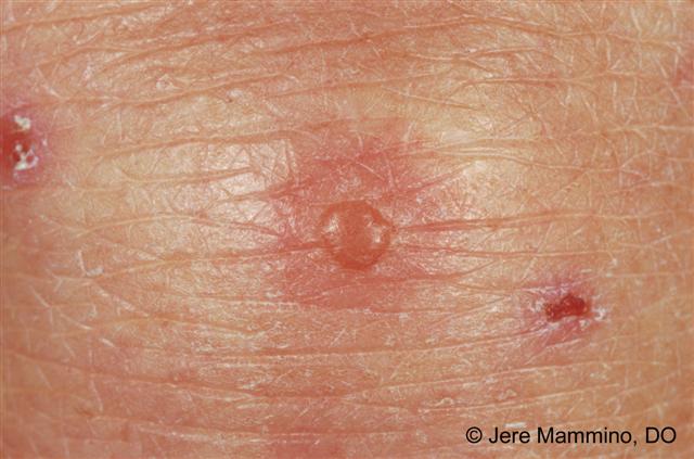 Closeup of dermatitis herpetiformis (source) 