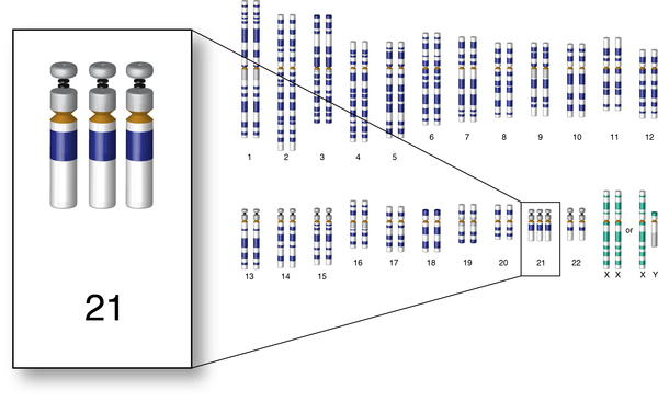 Down syndrome is a genetic disease resulting from a chromosomal abnormality. An individual with Down syndrome inherits all or part of an extra copy of Chromosome 21 (source). 