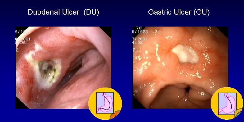 Appearance of duodenal and gastric peptic ulcers on endoscopy (source) 
