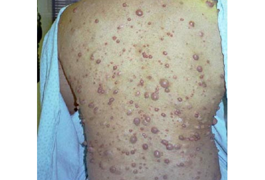 Neurofibromas in a patient with NF1 (source) 