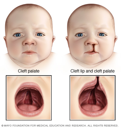 Palate abnormalities can be seen in patients with DiGeorge syndrome (source) 