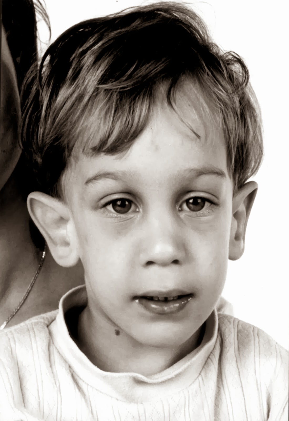 Child with fragile X syndrome (source) 