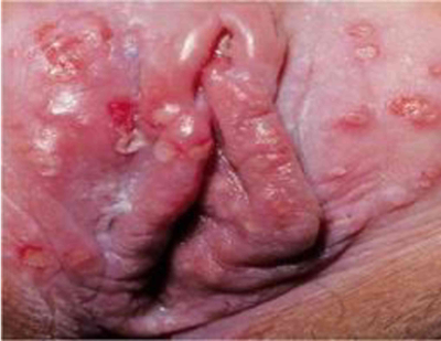 Clinical presentation of genital herpes in a female patient (source) 