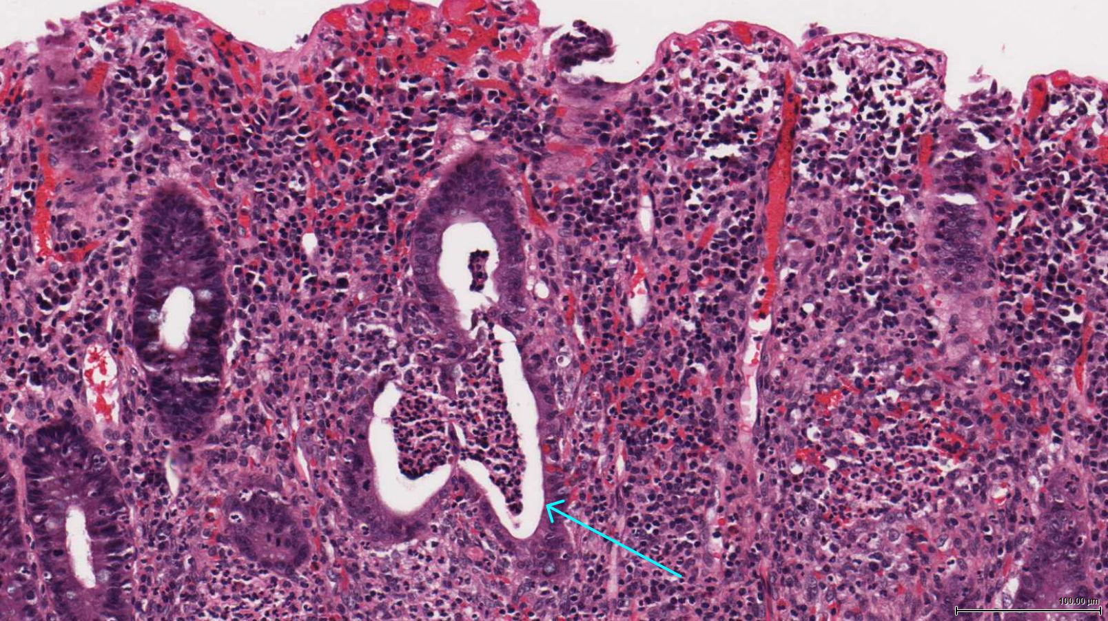 Histological appearance of ulcerative colitis. Blue arrow points to a crypt abscess (source)