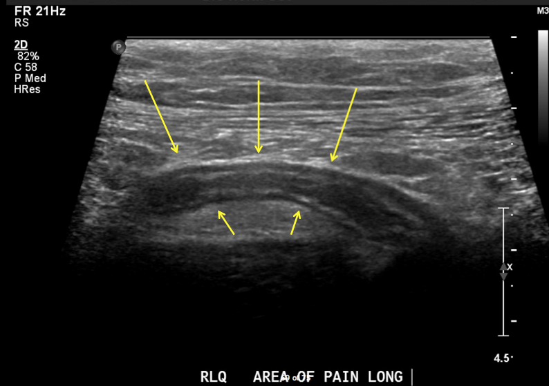 Appendicitis Stepwards appendicitis-stepwards