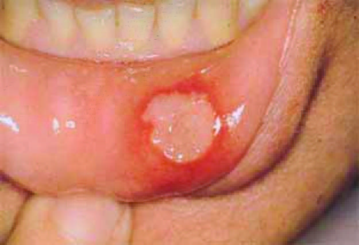 Clinical presentation of a canker store (source) 