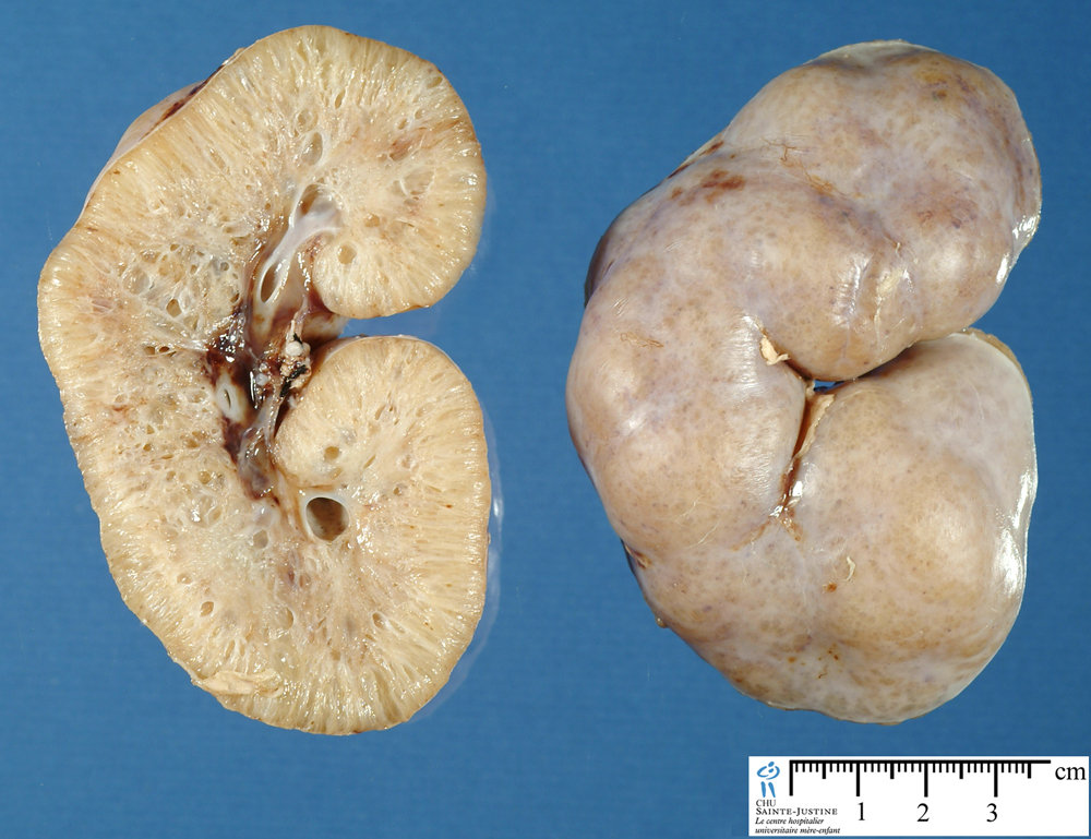 Gross appearance of ARPKD (source)
