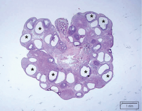 HIstological analysis of a polycystic kidney reveals many cystic follicles (asterisks) in the thickened cortex (source) 