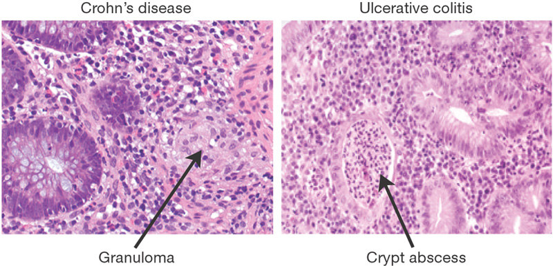 Comparison of histology between ulcerative colitis and Crohn disease (source)