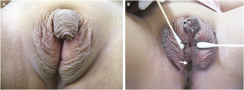 Ambiguous genitalia can be seen in newborns with CAH due to increased androgen production (source) 