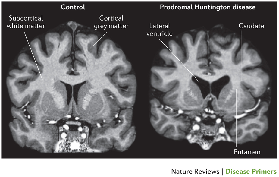 MRI findings of a patient with Huntington disease (source) 