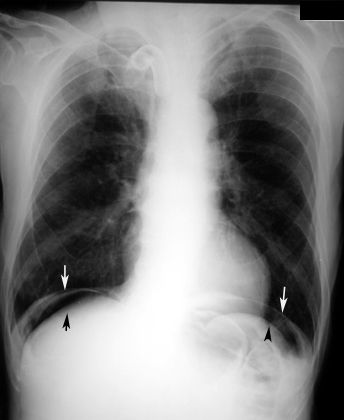 Free air under the diaphragm is a sign of bowel perforation and requires immediate surgical intervention (source) 