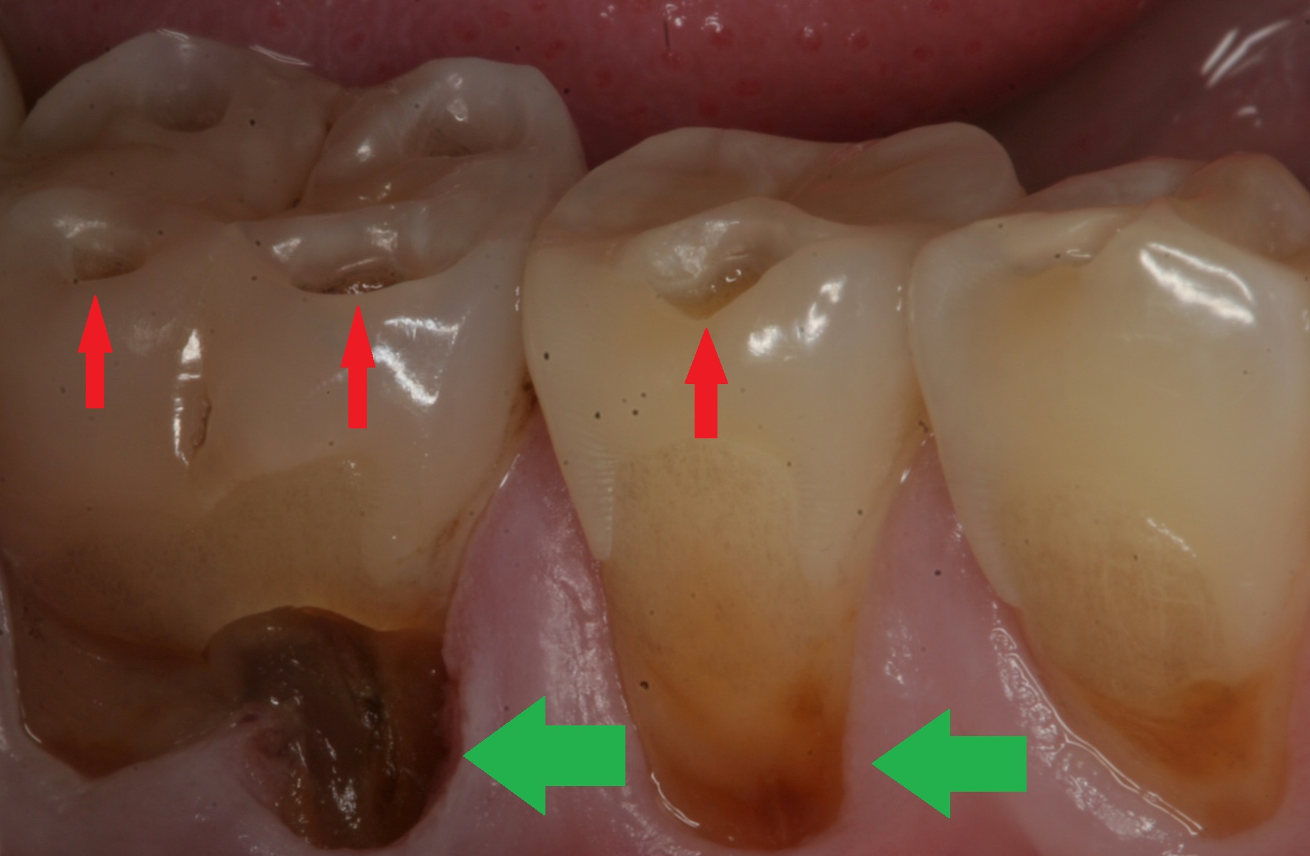 Severe tooth enamel erosion caused by untreated GERD (source)