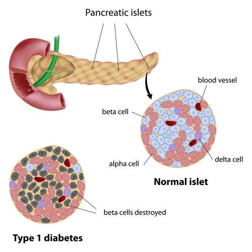 Type 1 diabetes is characterized by destruction of beta cells in the pancreas (source)