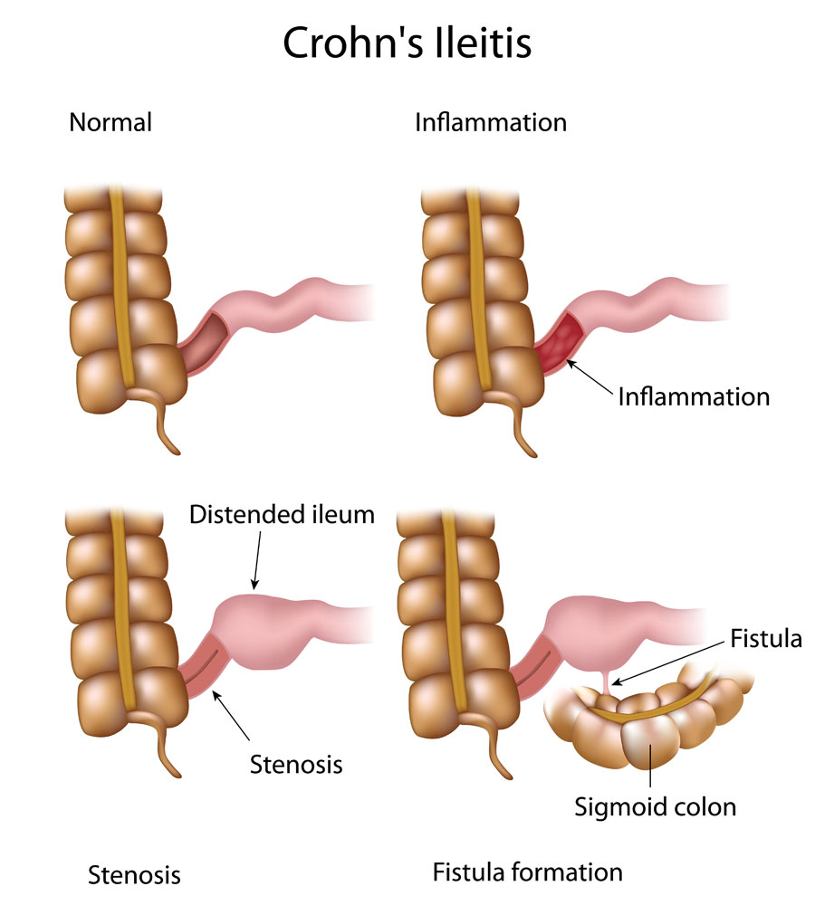 Crohn disease can lead to inflammation, stenosis, and fistula formation in the bowels (source) 