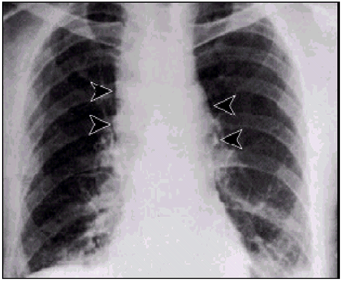 Mediastinal widening of a patient with pulmonary anthrax (source) 