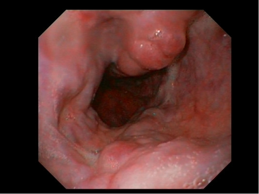 Esophageal varices in a patient with portal hypertension (source) 