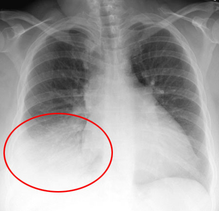 Pneumonia infiltrate in the right lower lung of a patient (source) 