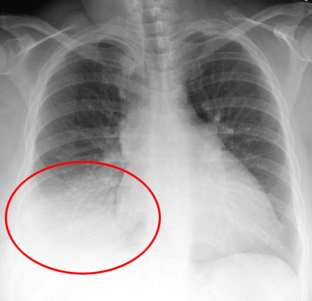 Pneumonia infiltrate in the right lower lung of a patient (source)