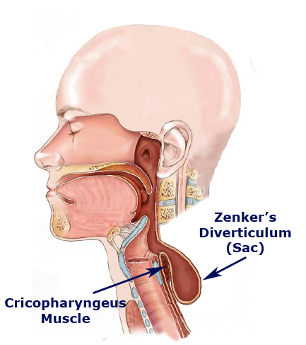 Anatomical location of Zenker diverticulum (source) 