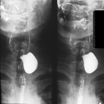 Visual appearance of Zenker diverticulum on barium swallow. Note the out-pouching on the esophagus that is retaining contrast (source) 