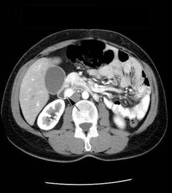 Contrast enhanced CT scan of a patient with a gastrinoma found in the duodenum (source) 