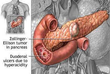 Anatomical location of a Zollinger-Ellison gastrinoma (source)