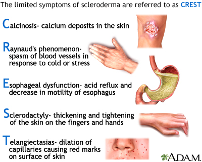 Symptoms of CREST syndrome (source) 