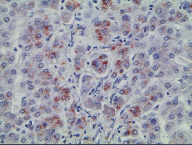 Liver biopsy of a patient with Wison disease staining positive with rhodanine (stain specific to copper, source) 