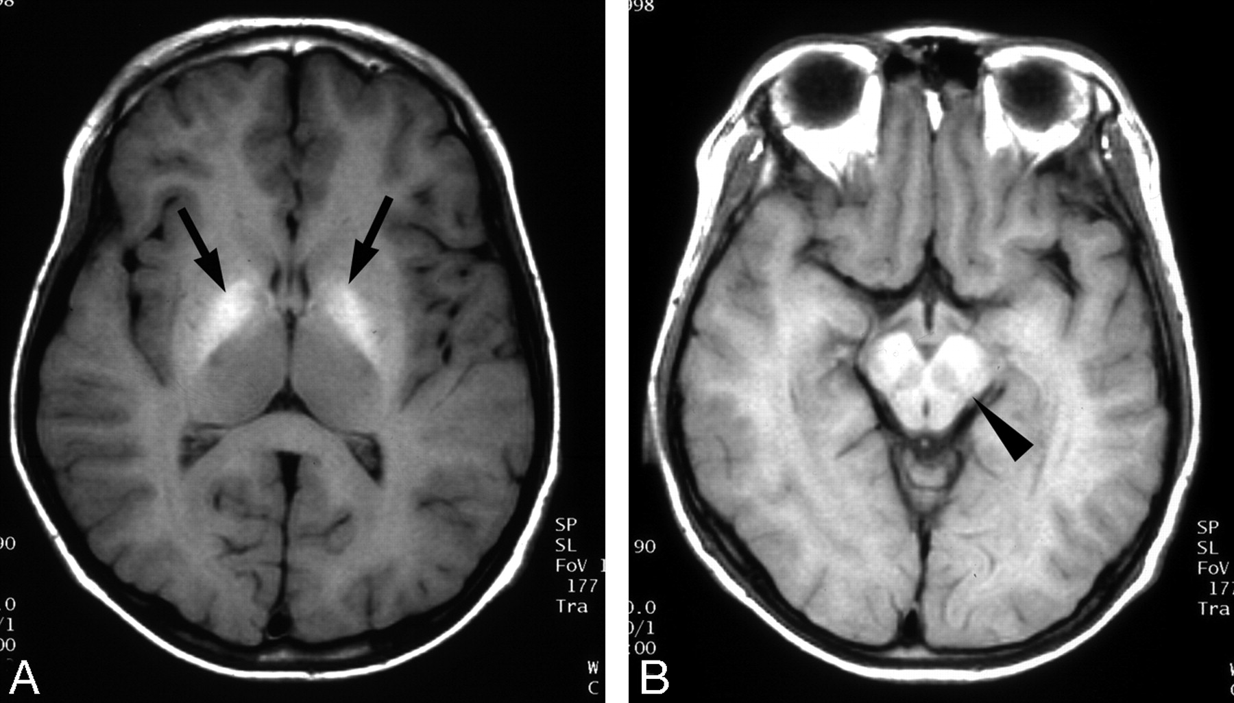 MRI of a patient with Wilson disease showing bilateral signal intensity in the globus pallidus (arrows) and the midbrain (arrowhead, source)